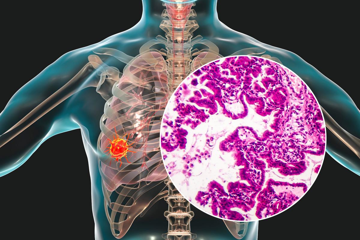 肺癌治疗取得重大进展，肺癌正在变成慢性??！长期生存已成为现实